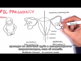 ectopic pregnancy - detailed overview