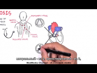 aortic stenosis at a glance