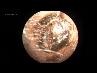 removing a huge piece of earwax from the ear