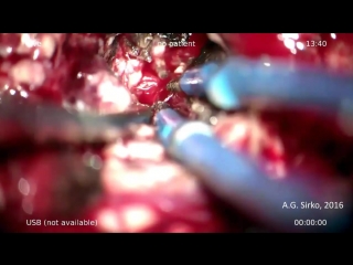 large cp angle hemangioblastoma part i