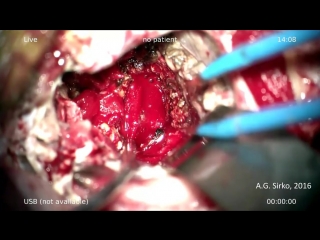 removal of a giant hypervascularized vestibular schwannoma on the left