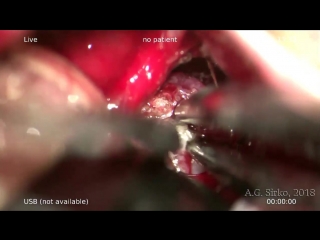 removal of a giant petroclival meningioma