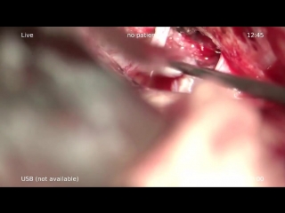 removal of a meningioma of the tubercle of the turkish saddle