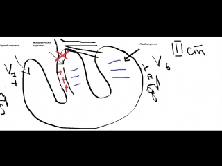 blockade of the right leg of the bundle of hys