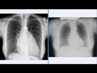 x-ray picture of the mitral heart shape