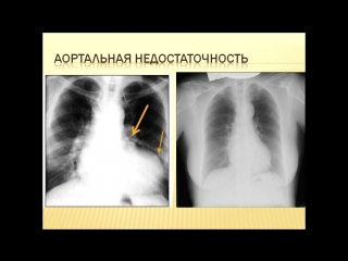 x-ray picture of the aortic heart shape