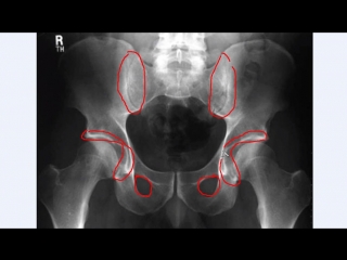 radiation anatomy of the pelvis