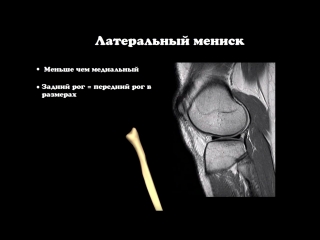 mri anatomy of the menisci of the knee joint