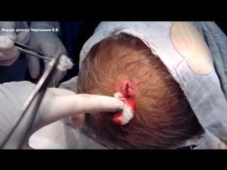 dermoid cyst of the scalp