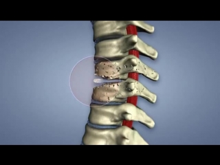 tuberculous spondylitis animation