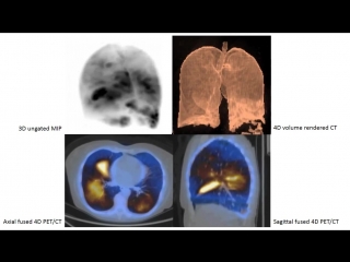 pet perfusion - ct of the lungs in pneumonia