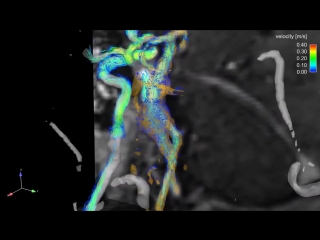 intracranial 4d - mr - angiography - hemodynamics in the aneurysm