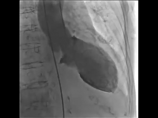 takotsubo cardiomyopathy in left-sided ventriculography