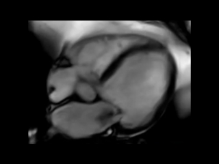 mri of the heart - mitral insufficiency