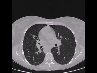 ct scans for kartagener's syndrome