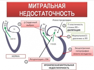 mitral insufficiency auscultation