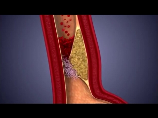 what does atherosclerosis look like?