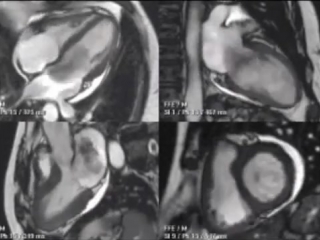 mri of the heart - left atrial myxoma