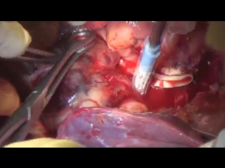 combined pneumonectomy with atrial resection under ec conditions (rsch named after academician b v. petrovsky)