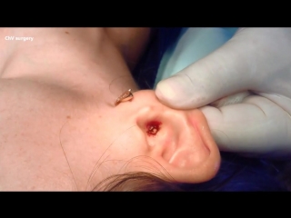 pyogenic granuloma of the skin of the right ear