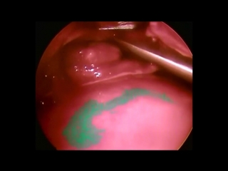 endoscopy removal of a cyst in the forehead