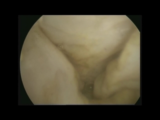 interstitial uterine fibroids. interstitial fibroids