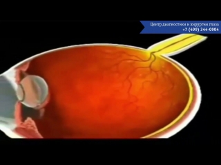 non-proliferative and proliferative diabetic retinopathy