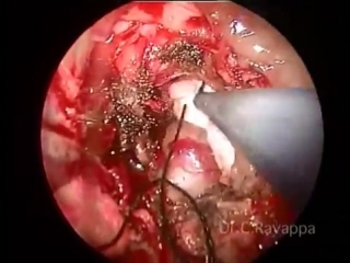 endoscopy removal of schwannoma from the infratemporal fossa