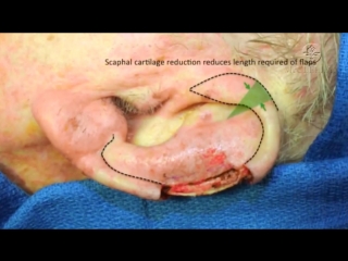 planning surgery for auricle defect plasty after tumor removal