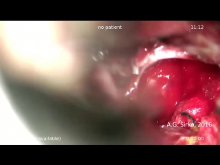 removal of pituitary adenoma by transnasal access part 2