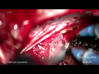 large cp angle hemangioblastoma part iii