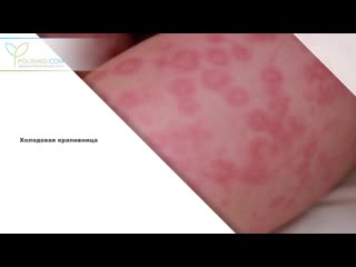 urticaria - causes, symptoms, what to do and what will help