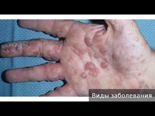 dyshidrosis. how to treat dyshidrosis.