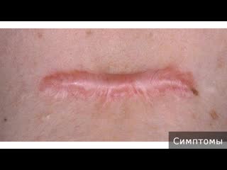 keloid scar. how to treat a keloid scar.