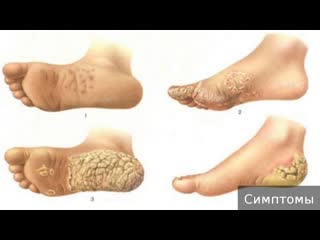 keratoderma. how to treat keratoderma.