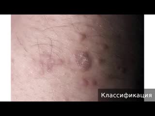 skin papillomas. how to treat skin papillomas.