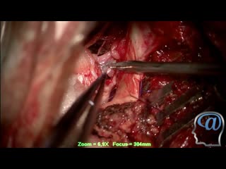 operation. removal of a meningioma of the foramen magnum