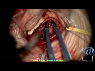 operation. removal of a brain tumor (keyhole access)