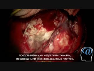 operation. removal of a tumor (teratoma) of the brain.