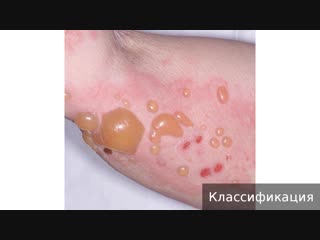 pemphigoid. how to treat pemphigoid.