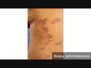 parapsoriasis. how to treat parapsoriasis.