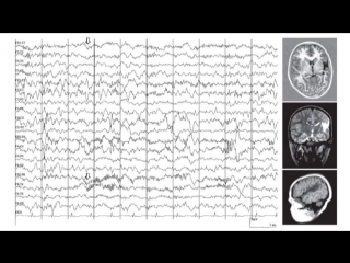 beta rhythm on eeg