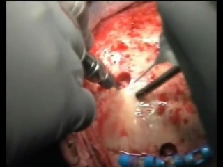 craniotomy - opening and closure, craneotomia, craniotomy