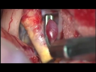 operation. clipping of an unruptured aneurysm of the internal carotid artery