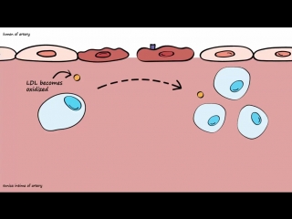 pathogenesis of atherosclerosis