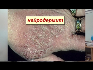 diagnosis of psoriasis. how to distinguish psoriasis from lichen, neurodermatitis, eczema and dermis