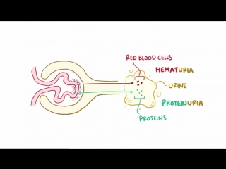 poststreptococcal glomerulonephritis lecture osmosis