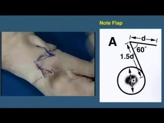 closure of a round defect