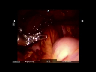 robotic-assisted radical cystectomy with intracorporeal neobladder formation