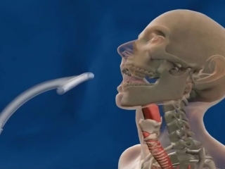 installation of a portex laryngeal mask